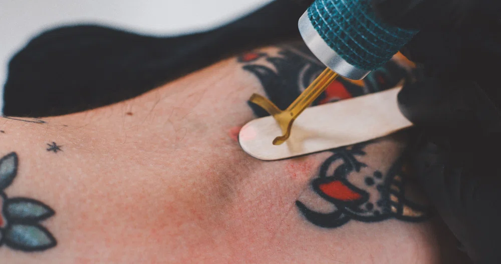 removing a tattoo with laser